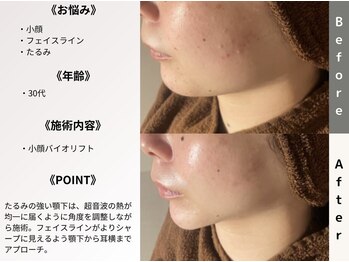 ルディラ医療提携エステ 立川店 毛穴/小顔/ニキビ・シミ・美白・シワ・たるみケア/小顔バイオリフト