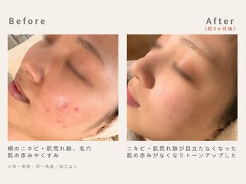 メレ(mele)/20代赤み/ニキビケア・毛穴
