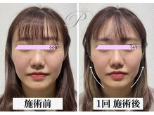 パールリフト 小田原店/つや肌リフト　高濃度美容液導入