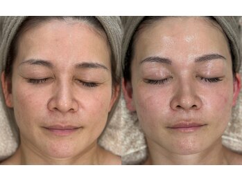 レボン(rebon)/【ボンバー】ビフォーアフター