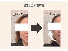 ココ センガ ビューティー クリニック(COCO SENGA Beauty-Clinic)/COCO　インモード　１回の効果