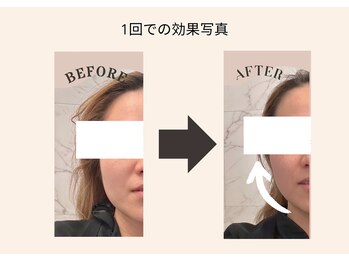 ココ センガ ビューティー クリニック(COCO SENGA Beauty-Clinic)/COCO　インモード　１回の効果