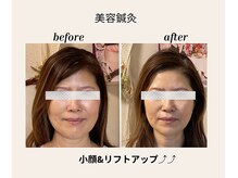 美肌脱毛 ビハダモ(Bihadamo)の雰囲気(おススメ!光フォト+美顔鍼でキュっとアップ。目疲れ・むくみ◎)