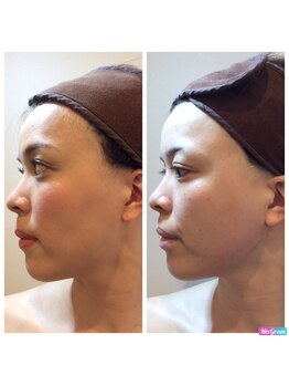 ミエル(Miel)/Before　after