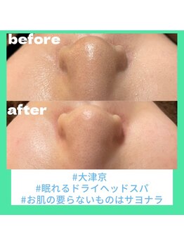 リックス(RIX)/女性 &nbsp;毛穴洗浄♪