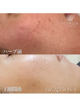 ピアーノ(PIANO)/エルモサハーブピーリング