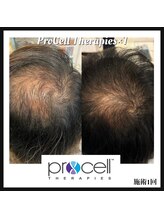 ヒルナム(Heal Nam)/プロセルセラピーズ　~頭皮~