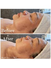 エメ(Aimer)/韓琉小顔キツネリフトで決まり！