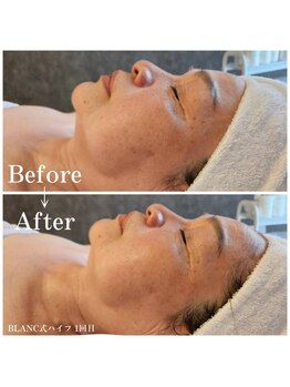 エメ(Aimer)/韓琉小顔キツネリフトで決まり！