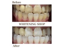 ホワイトニングショップ 明石大久保店/【BeforeAfter】