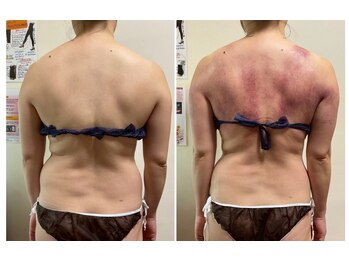 ニコワ(Nicowa)/Nicowaの痩身★BeforeAfter