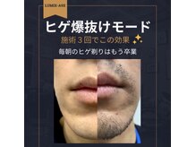 毎朝の髭剃りはもう卒業！他脱毛メニューもあります！