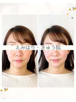 えみはりきゅう院/口角もキュッと上がる美容鍼♪
