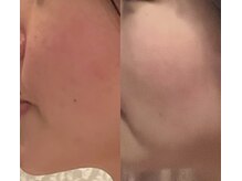 エン(EN)/美白＆滑らか肌へ