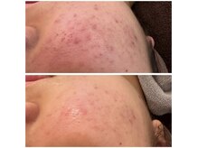 グランデ(Grande)/プラズマ＋ハーブでニキビケア◎