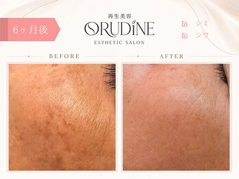オルディーネ(ORUDiNE)/シワ改善ハリ肌