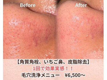 アクシア ビューティー サロン(AXSIA)の写真/いちご鼻や毛穴のザラツキをケアして美肌を目指しメイクのりUPをサポート☆