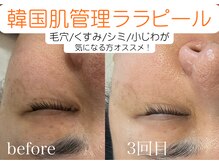 グレイティア(gratia)の雰囲気（毛穴洗浄＆ララピールの毛穴特化クーポン掲載中！）