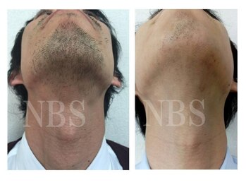 ブロンズ(BRONZE)/メンズ脱毛≪3回目≫