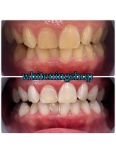 ホワイトニングショップ 大阪玉造店/Before&After美白ホワイトニング