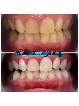 ホワイトニングショップ 大阪玉造店/Before&After美白ホワイトニング