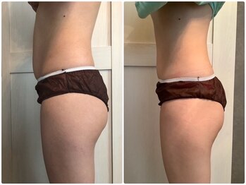 アンドモア(&more)/痩身症例