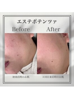 モア 渋谷店(MOA)/エステポテンツァBefore After！
