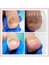 巻き爪補正店 大阪なんば店/深爪