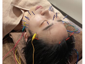 世田谷ビューティークリニークの写真/《美容鍼で小顔効果と美肌効果の一石二鳥》お顔のトーンアップ/リフトアップ効果でお顔悩みを一気に解決★