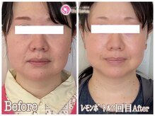 ジ エステティック イーズ ららぽーと福岡店の雰囲気（顔を大きく見せる厚い脂肪へ【レモンボトル】FACE体験￥8800）