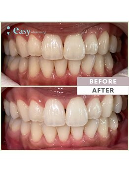 イージーホワイトニング 中野店(easy whitening)/セルフホワイトニング症例写真