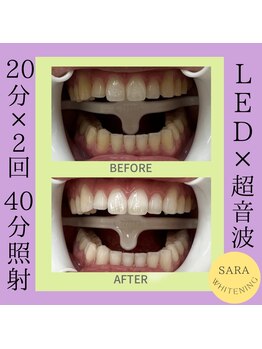 ココティ ホワイトニング(Cocotii)/ビフォーアフター！