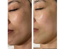 アドビューティ(Add Beauty)/≪小顔リフト／シワたるみ改善≫