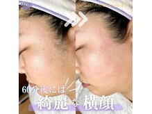 ニカット(nikatto)の雰囲気（マリムーブフェイシャルワックスで毛や古い角質を取り除きます☆）