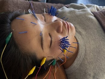 まつもと美容鍼灸整体サロン/【人気No.1】リフトアップ美容鍼