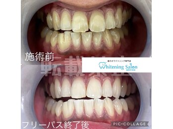 ホワイトニングサロン 福岡天神店/ホワイトニング