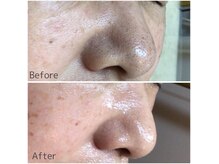 メープルサロン(MAPLE SALON)の雰囲気（長年変わらなかった毛穴の詰まり・黒ずみも変化！）