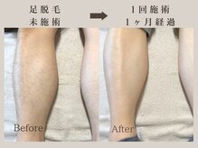 ワンアップ(One-up)の雰囲気（【夏の準備は今から★】脱毛経験がある方ほど効果の違いに驚く！）