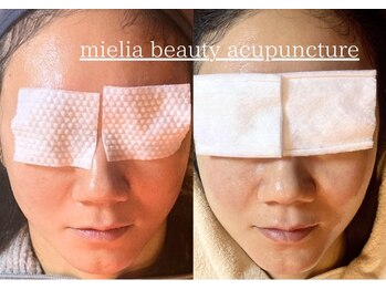 ミエリア美容鍼灸院(mielia美容鍼灸院)/カスタム美容鍼灸30本