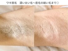 アンシャンテ 芦屋店/芦屋 西宮で美肌脱毛・ワキ脱毛