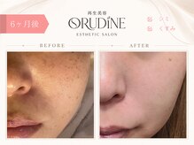 オルディーネ(ORUDiNE)/シミ改善ケア