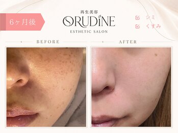 オルディーネ(ORUDiNE)/シミ改善ケア