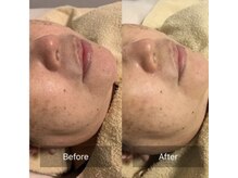 ファヴォリ(favori)/美白美容液導入