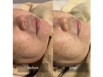 ファヴォリ(favori)/美白美容液導入