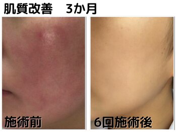 ビープラス(Biplus)/３か月の驚きの肌質改善の結果！