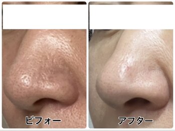 アンジェーム(angeame)/徹底的に毛穴洗浄☆