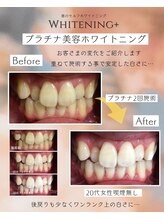 ホワイトニングプラス(Whitening+)/プラチナ美容ホワイトニング