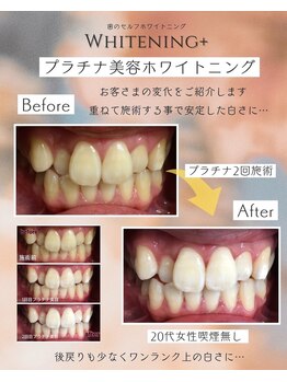 ホワイトニングプラス(Whitening+)/プラチナ美容ホワイトニング