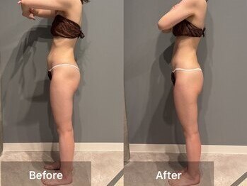 シャイニーシャイニー 金沢店(SHINY/SHINY)/スリムムーヴ痩身症例