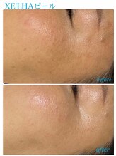 プレジール(Plaisir)/韓国人気No. 1 XE'LHAセラピール